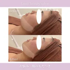  Lapis beauty salon　小顔リフトUP