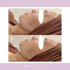 　Lapis beauty salon　小顔リフトUP