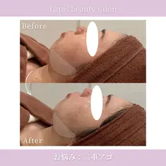 Lapis beauty salon 小顔リフトUP